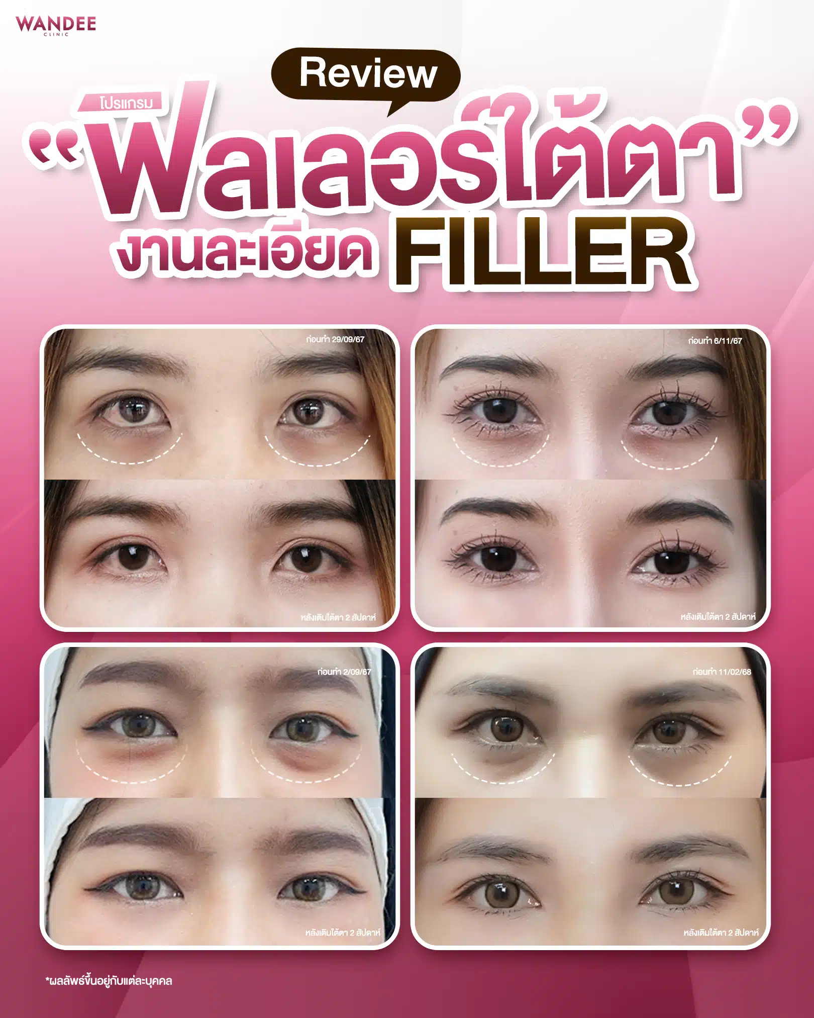 รวมรีวิวฟิลเลอร์ใต้ตา Wandee clinic