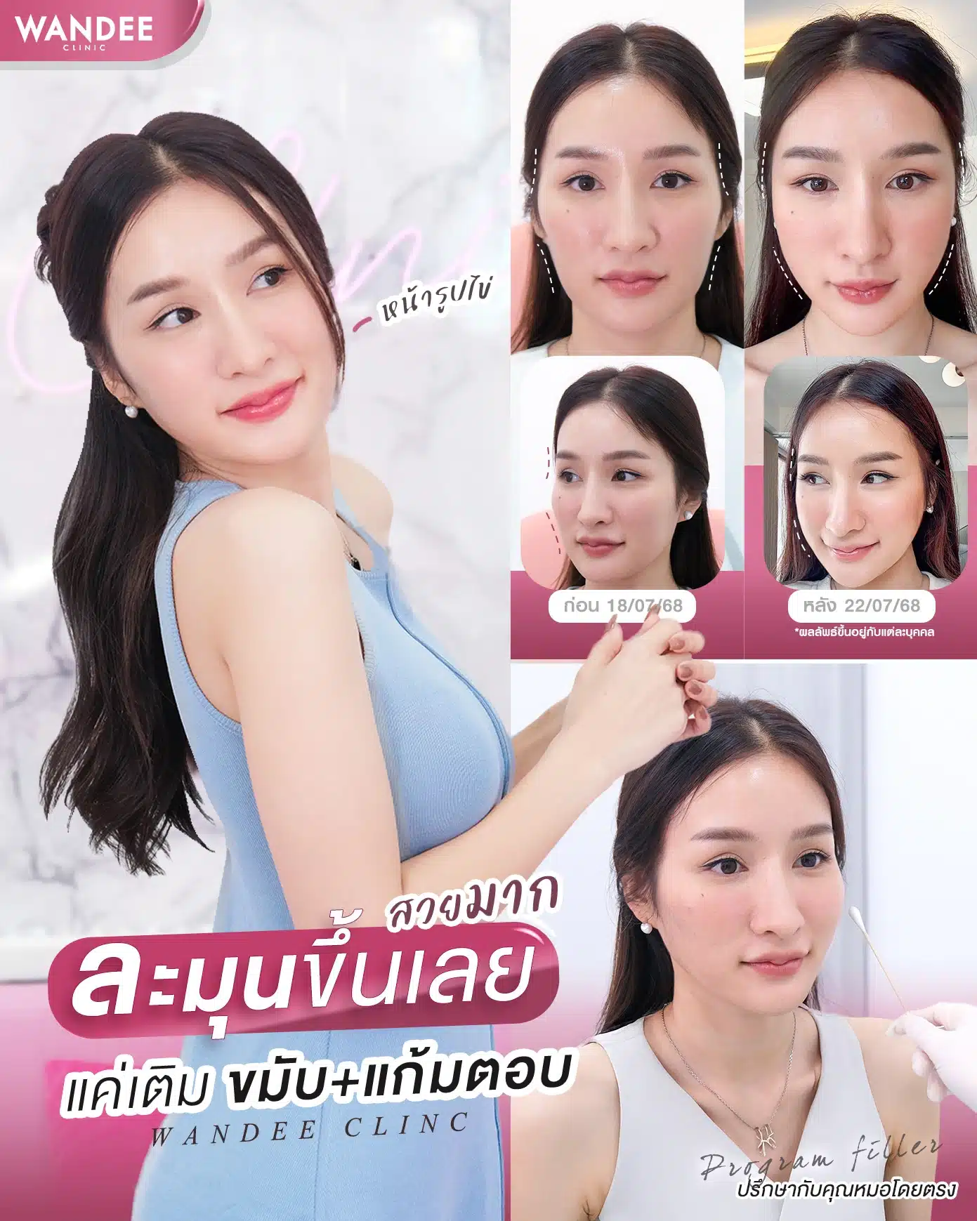 รีวิวฟิลเลอร์ขมับ+ร่องแก้ม Wandee clinic