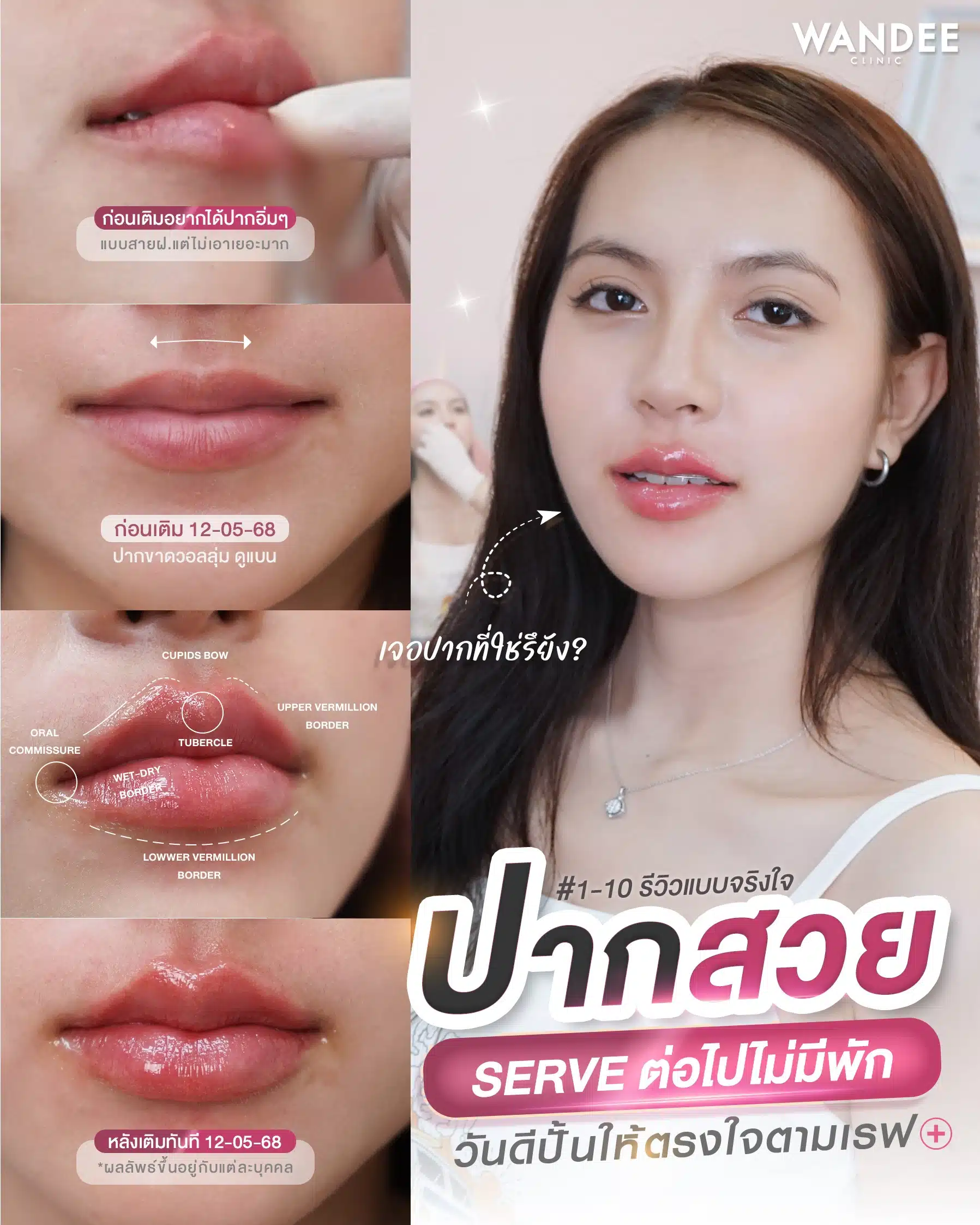 รีวิวฟิลเลอร์ปาก Wandee clinic