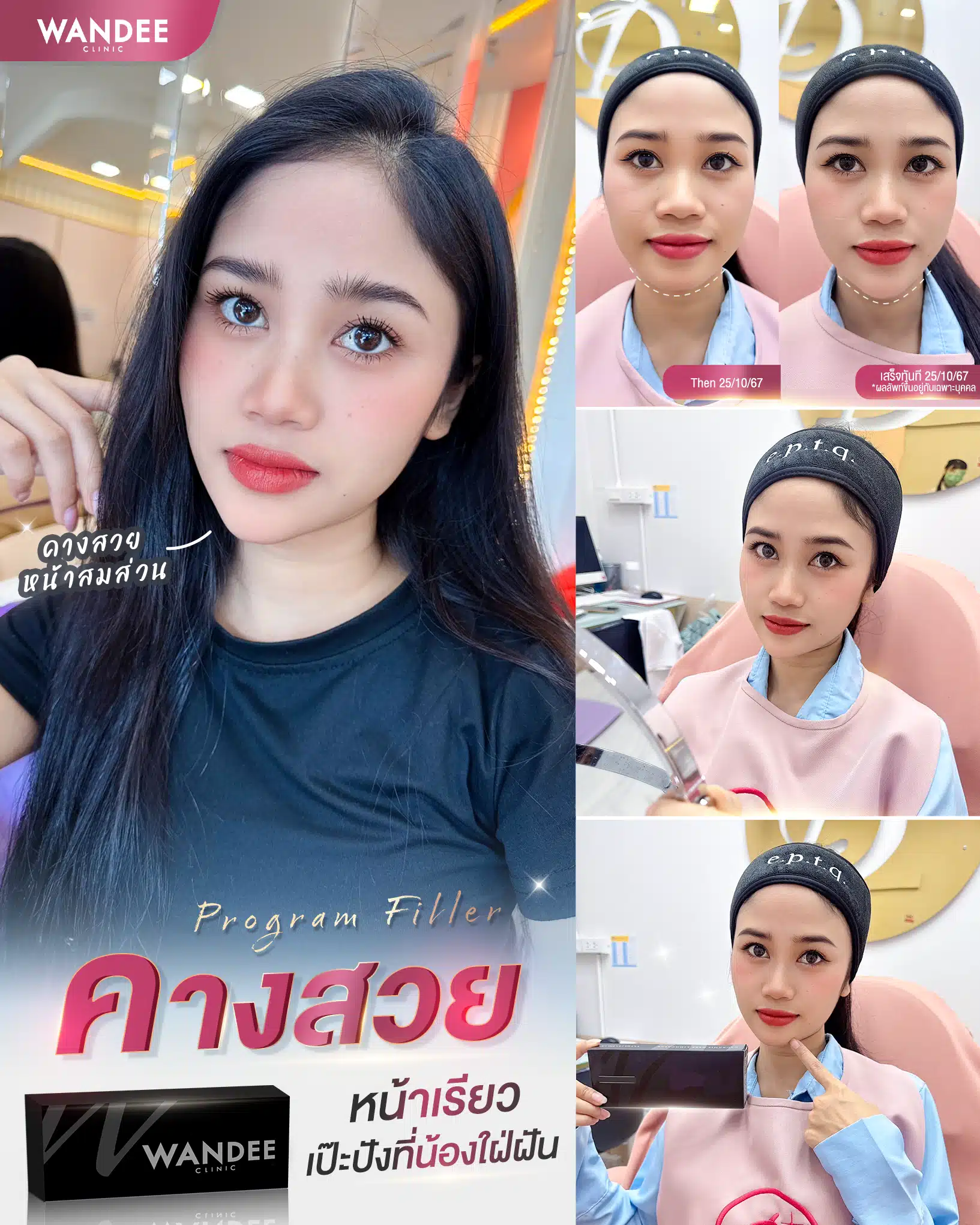 รีวิวฟิลเลอร์คาง Wandee clinic