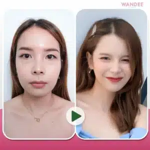 รีวิวโบท็อกซ์ Wandee Clinic