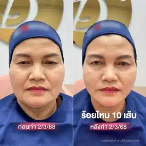 รีวิวร้อยไหม Wandee Clinic