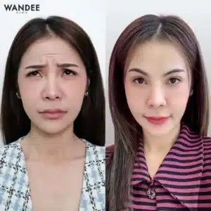 รีวิวโบท็อกซ์ Wandee Clinic