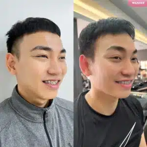 รีวิวโบท็อกซ์ Wandee Clinic