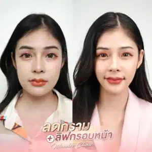 รีวิวโบท็อกซ์ Wandee Clinic
