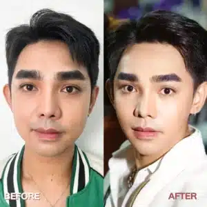 รีวิวโบท็อกซ์ Wandee Clinic