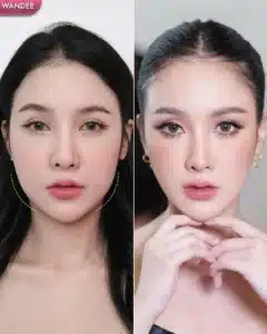 รีวิวโบท็อกซ์ Wandee Clinic