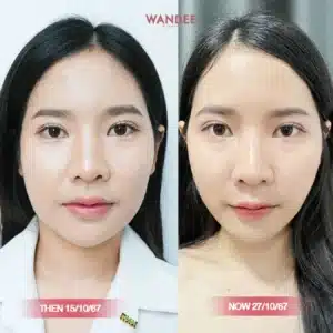 รีวิวโบท็อกซ์ Wandee Clinic