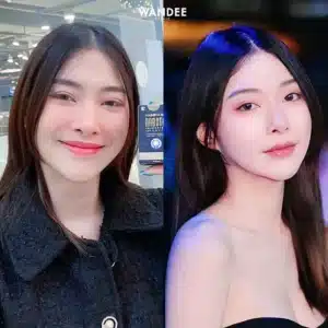 รีวิวโบท็อกซ์ Wandee Clinic