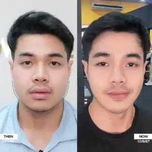รีวิวโบท็อกซ์ Wandee Clinic