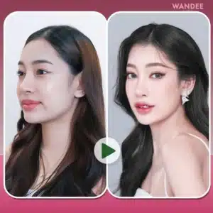 รีวิวโบท็อกซ์ Wandee Clinic