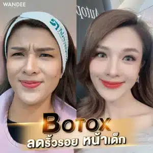 Botox ลดริ้วรอย