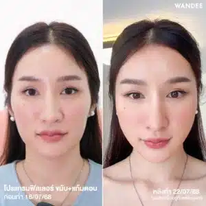 รีวิวฟิลเลอร์ขมับ Wandee Clinic