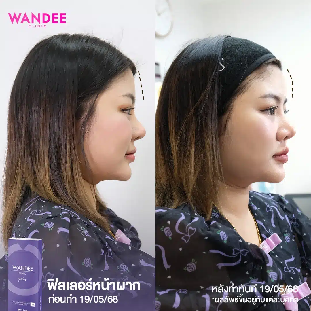 รีวิวฟิลเลอร์หน้าผาก Wandee Clinic