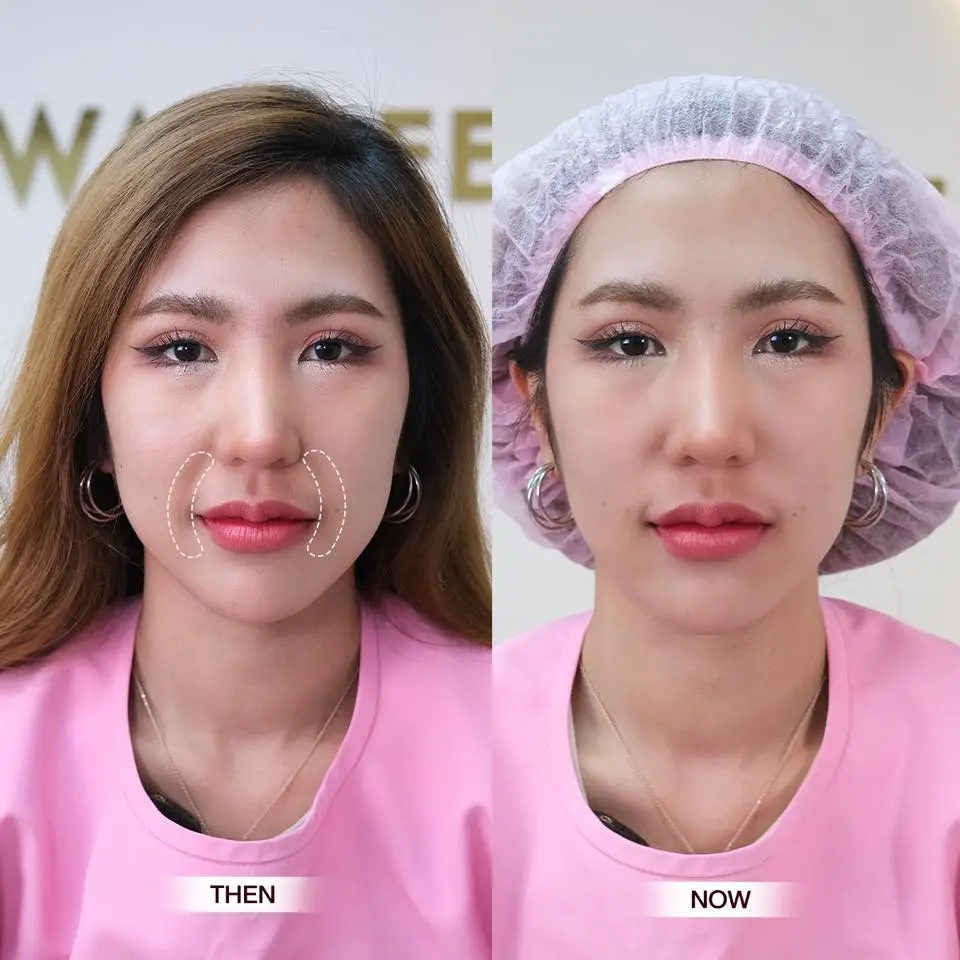 รีวิวฟิลเลอร์ร่องแก้ม Wandee Clinic