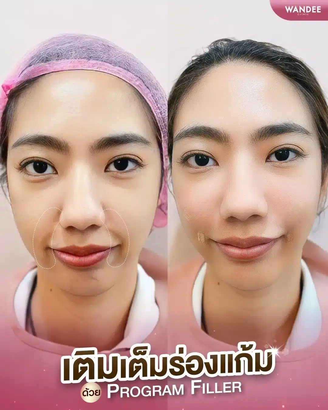 ทำไมต้อง ฉีดฟิลเลอร์ร่องแก้ม โคราช ที่ วันดีคลินิก ?