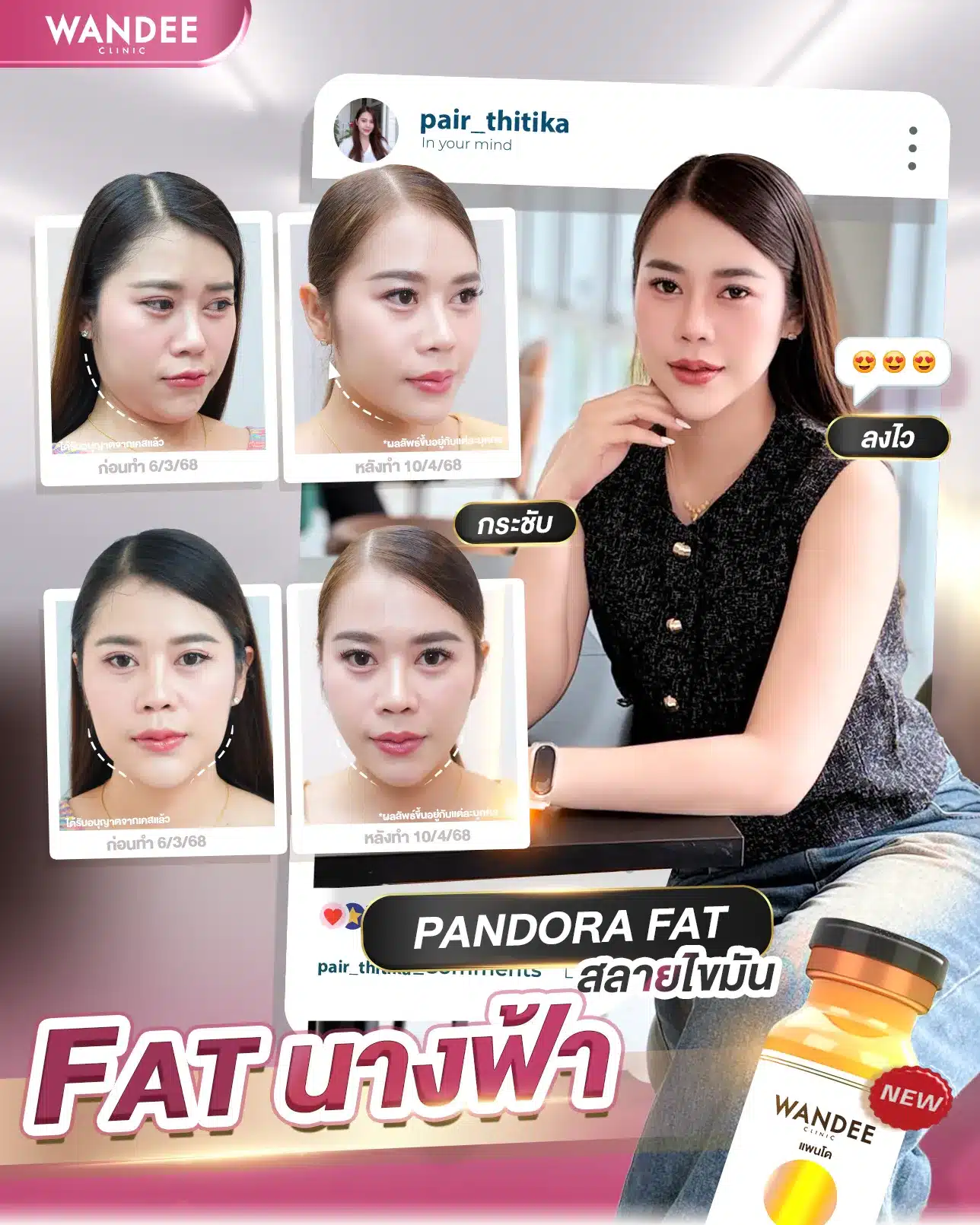 ฉีดเมโสแฟต โคราช ดีไหม? มีข้อดีข้อเสียอะไร ฉีดบ่อยดื้อยาไหม?