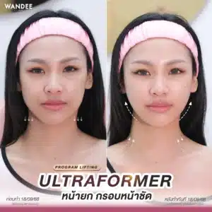 รีวิว Ultraformer ที่ Wandee Clinic