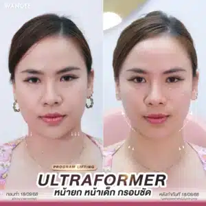 รีวิว Ultraformer ที่ Wandee Clinic