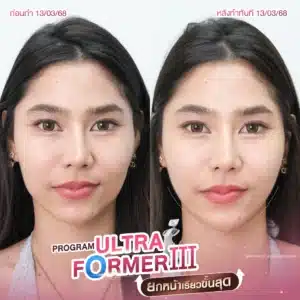 รีวิว Ultraformer ที่ Wandee Clinic
