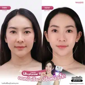 รีวิว Ultraformer ที่ Wandee Clinic