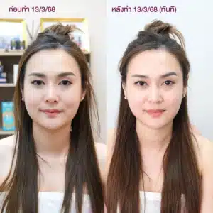 รีวิว Ultraformer ที่ Wandee Clinic
