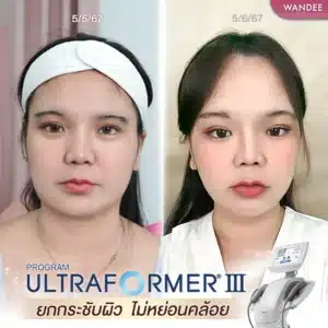 รีวิว Ultraformer ที่ Wandee Clinic