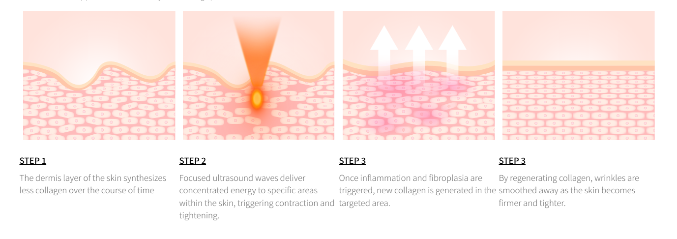 Ultraformer ที่ Wandee Clinic